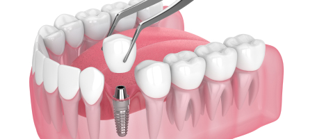 single-tooth implant