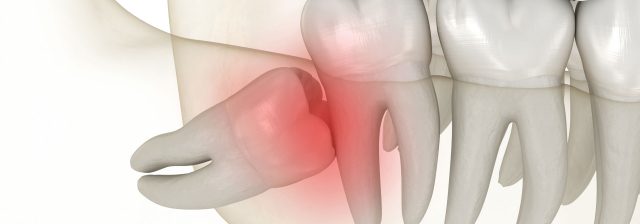 impacted wisdom tooth