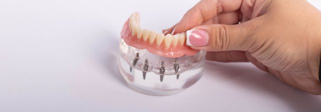 all-on-4 dental implants